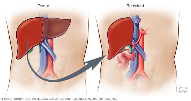 Liver Transplantation - HPB Surgery Service